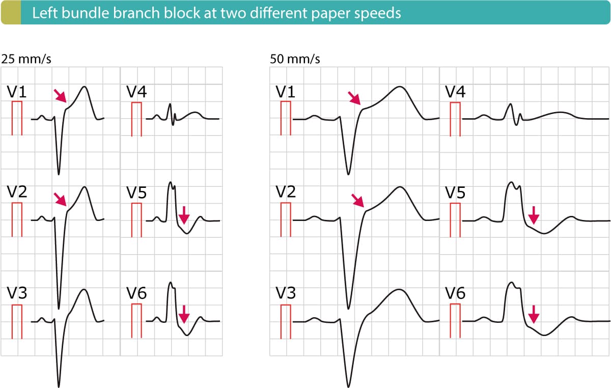 Illustration ur kursen EKG-tester (Quiz)